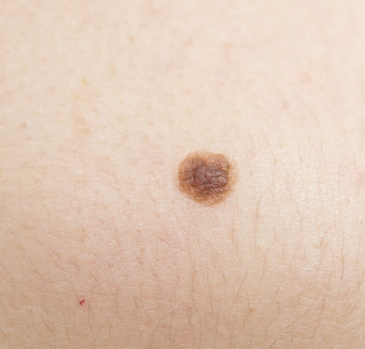 Key Genetic Factor Controls Mole Development Into Melanoma