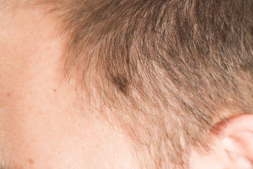 Advanced Head and Neck Melanomas Often Found Where They’re Hardest to See