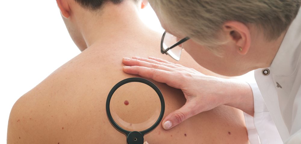 Specialized Melanoma Surveillance Provides Better Outcomes, Lower Costs than Standard of Care, Study Finds