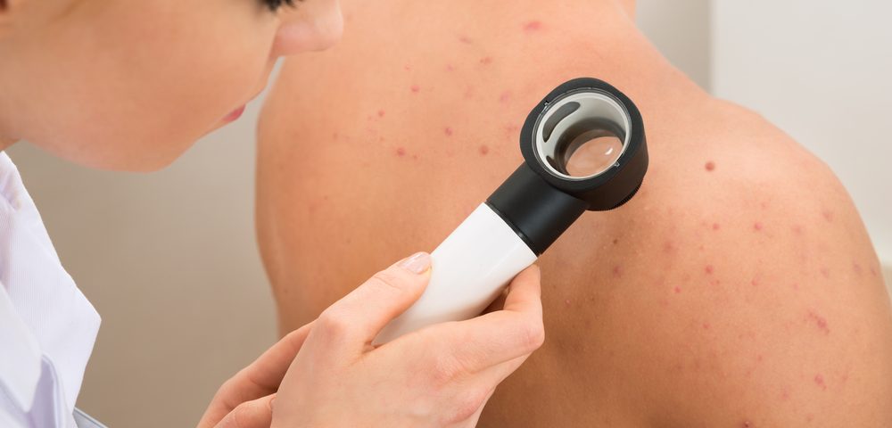 Risk Factors for Melanoma May Influence When and Where Disease Strikes
