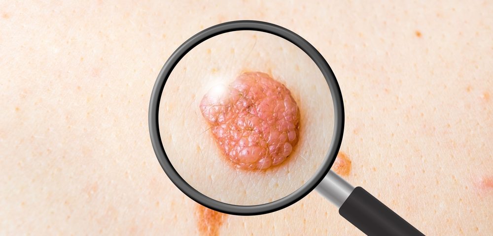 Results of Mole Mapper Mobile-app-based Skin Cancer Study Are in
