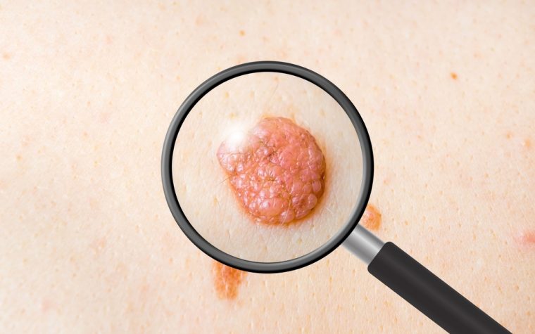 Mole Mapper melanoma results